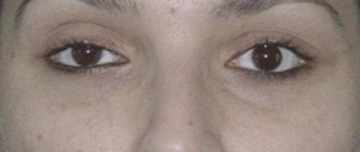 eye asymmetry after blepharoplasty, asymmetry after blepharoplasty, eyelid blepharoplasty complications, eyelid blepharoplasty reviews complications, upper eyelid blepharoplasty complications photo