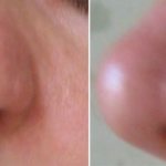 nasal asymmetry