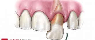 Autotransplantation of teeth