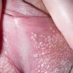 white spots on the labia