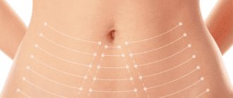 non-surgical abdominal skin tightening APTOS Body