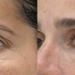 Biorevitalization of the skin around the eyes