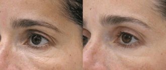 Биоревитализация кожи вокруг глаз