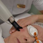 Is it painful to remove blood vessels with a laser?