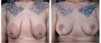 Large nipple areolas 1