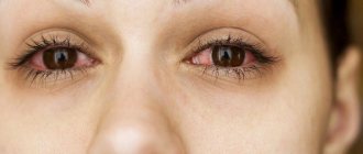 Eyes hurt after eyelash extensions