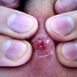 What kind of clear liquid flows out when you squeeze a pimple? photo