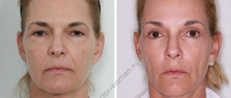 Before and after endoscopic brow lift and blepharoplasty of the upper and lower eyelids 4 months after surgery