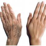 Loose skin on hands - how to restore and preserve their youth for a long time 1