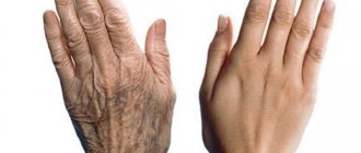 Дряблая кожа рук – как вернуть и надолго сохранить их молодость 1