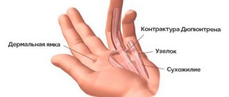 Dupuytren&#39;s contracture description