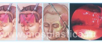 Endoscopic forehead lift