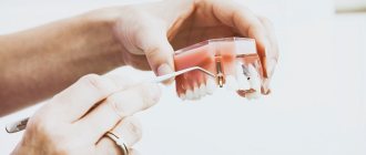 stages of dental implant installation