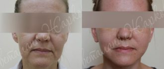 photos before and after facelift