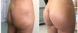 Photos before and after buttock augmentation with plastic surgeon Dmitry Krysin