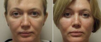 Фото лица до и после применения геля Стилаж