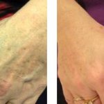 Phototherapy for age spots on hands