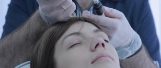 Fractional mesotherapy of the scalp