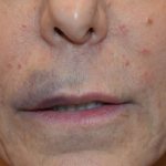 Lip hematoma after contour plastic surgery photo