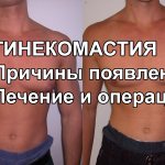 Gynecomastia - causes, treatment and removal operations, ICD-10, photo