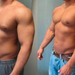 Gynecomastia in bodybuilding