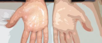 Hyperhidrosis - How to get rid of wet palms and feet?