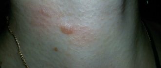 A hypertrophic scar developed a month after mole removal