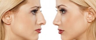 A hump on a girl&#39;s nose. Beautiful or not, how to remove without surgery, rhinoplasty 