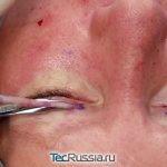 surgical eyelid surgery