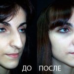 Изменение длины носа
