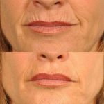 how to remove facial wrinkles around the mouth