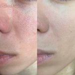 skin before and after