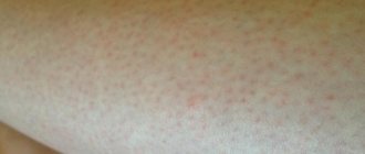 Red dots after hair removal: 3 best remedies