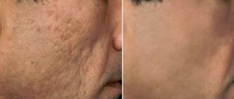 Laser scar resurfacing before and after