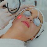 Laser resurfacing of post-acne scars