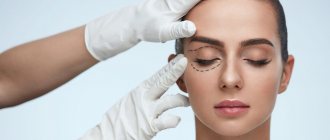 Laser resurfacing of the area around the eyes