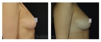 Breast lipofilling before and after photos