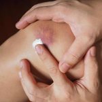 best remedies for bruises