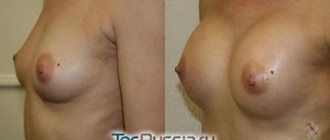 Macrolane for breasts, before and after photos