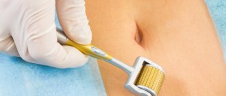 Mesoscooter for the body against cellulite: how to use, contraindications, review of drugs for mesotherapy