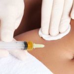 mesotherapy of the abdomen, injection of drugs into the abdomen