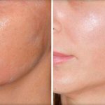 Миостимуляция - процедура для омоложения кожи лица