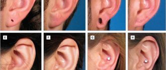 Is it possible to fill holes in the ears?
