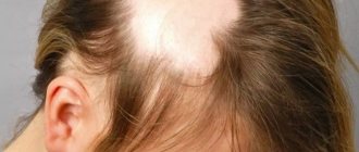 Alopecia areata - causes and treatment.jpg
