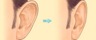 Ear otoplasty
