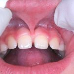 Laser lip frenuloplasty
