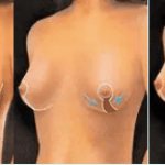 Подтяжка груди, мастопексия
