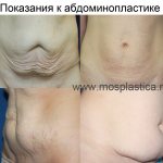 indications for abdominoplasty