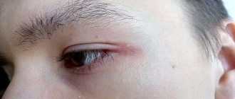 Redness in the corners of the eyes