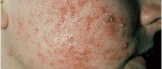 Polymorphism of acne elements on the patient&#39;s cheek